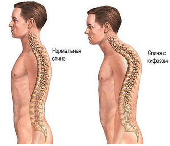 Кифоз повоночника