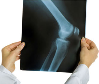 Лечение артроза коленных суставов в одессе thumbnail