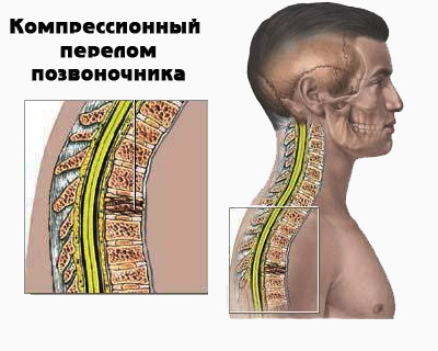 компресійний перелом хребта
