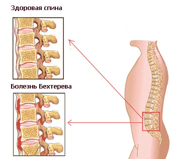 болезнь Бехтерева