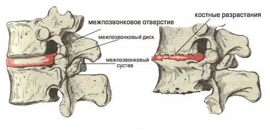 Остеохондроз хребта