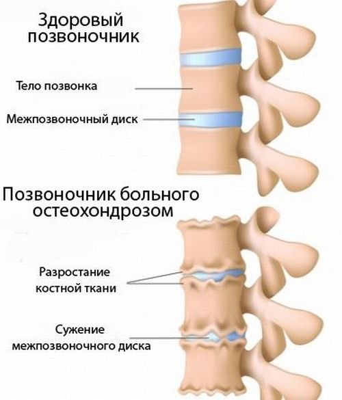 остеохондроз хребта